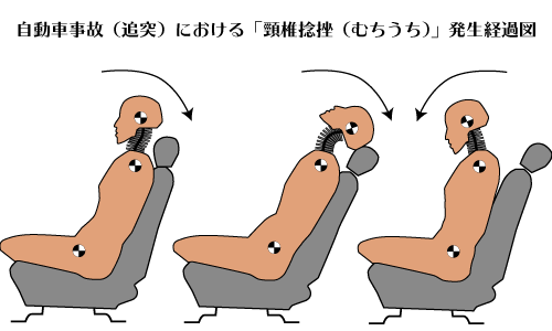 自動車事故(追突)における「頸椎捻挫(むちうち)」発生経過図